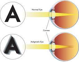 Illustratie van het verschil tussen een normaal oog en een oog met astigmatisme (cilinder)