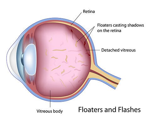 Illustratie van floaters in het glasvocht van het oog